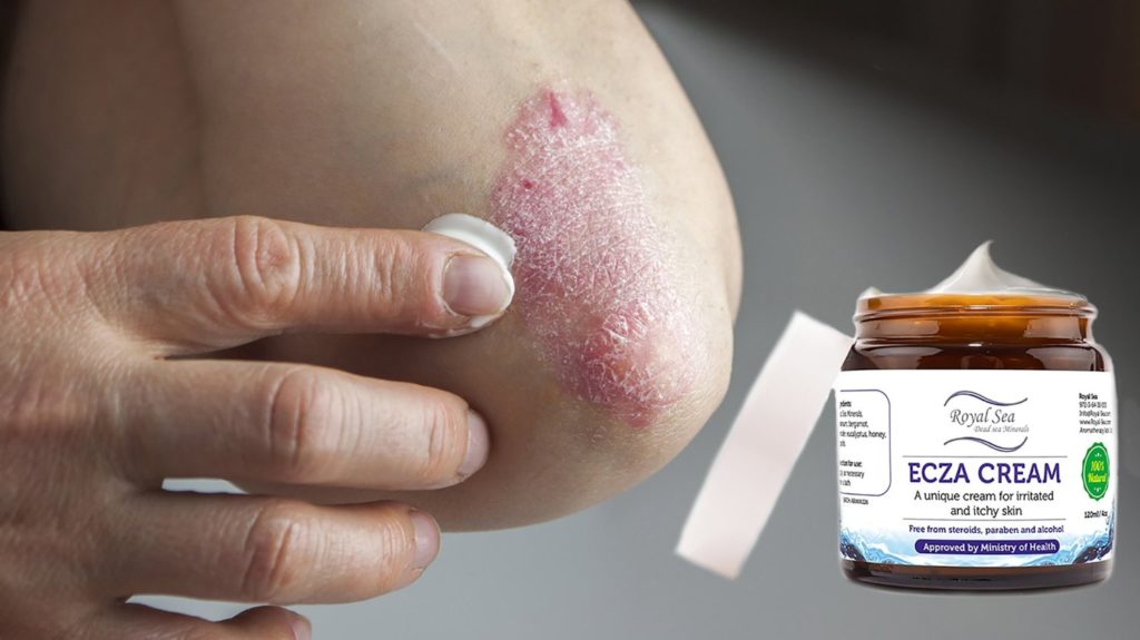 natural-eczema-treatment